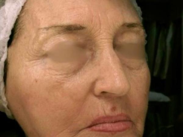 Удаление пигментных пятен после